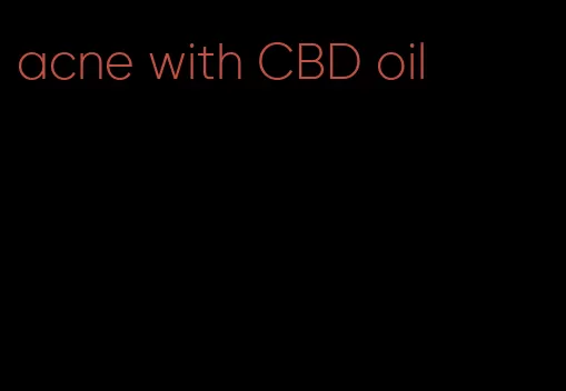 acne with CBD oil